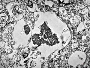 M,71y. | Alzheimer diseaseaccompanied with CADASIL - hyaline body in astrocyte